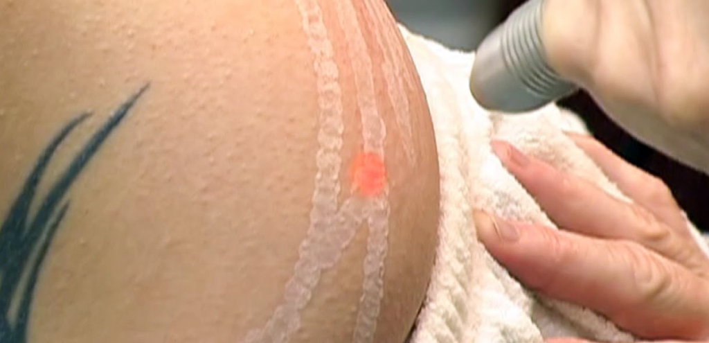 Laser Stretch Mark Removal Treatment Dermatologists