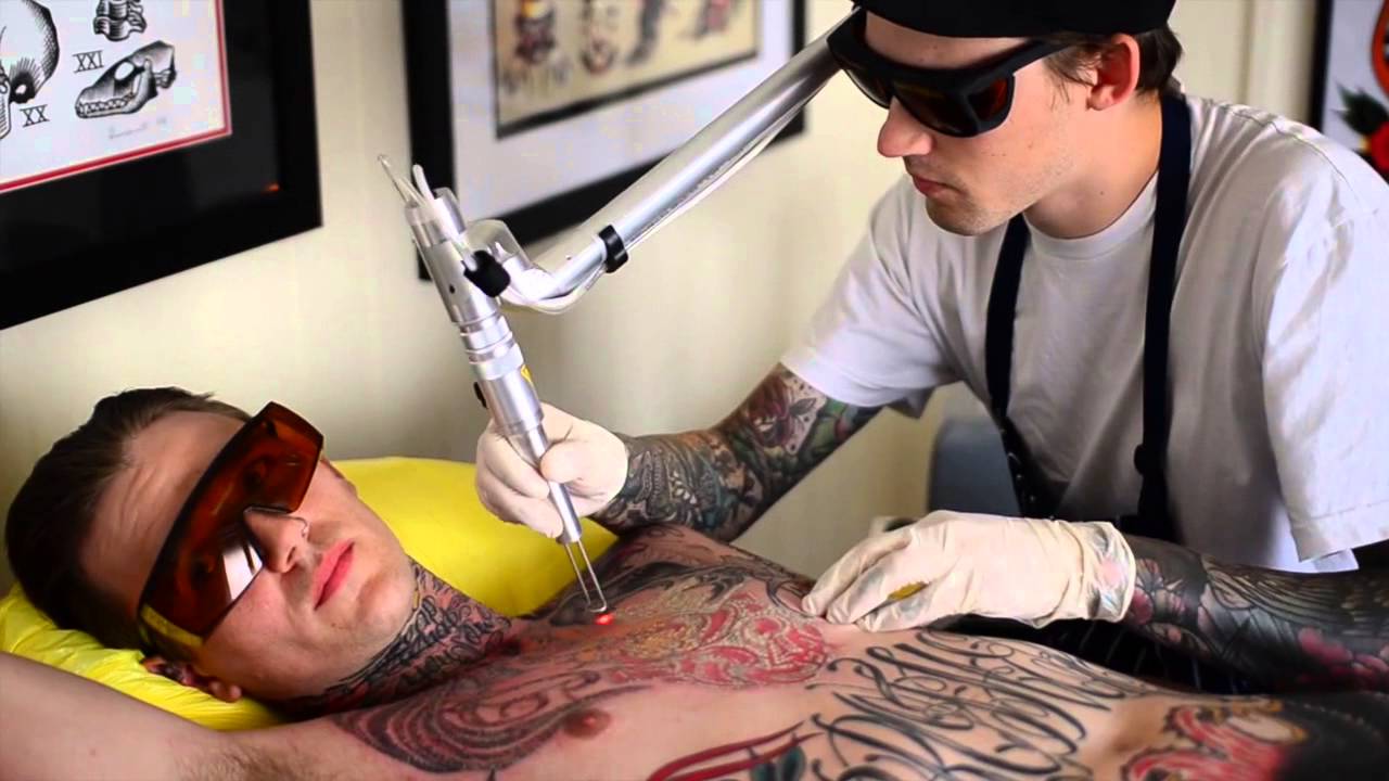 best tattoo removal Gold Coast