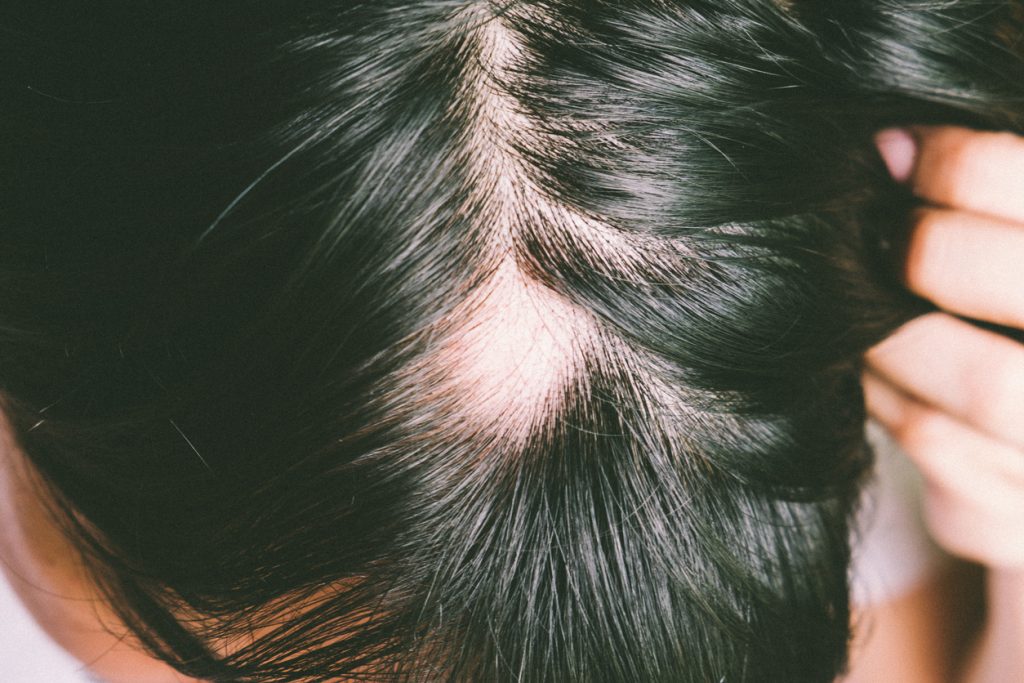 Alopecia Treatment