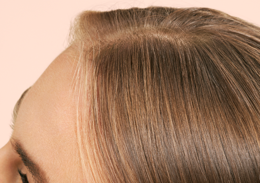 Alopecia in Women