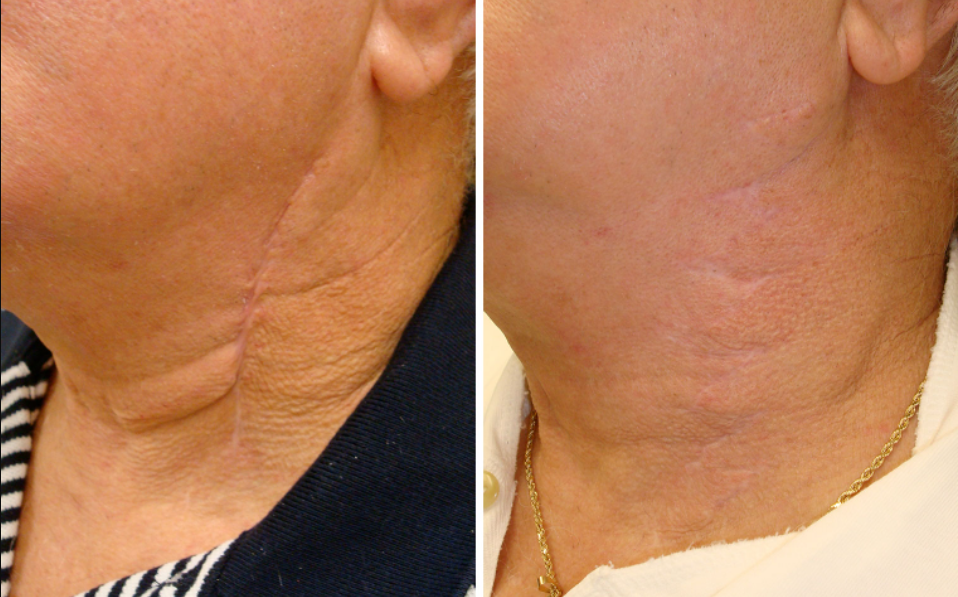 scar treatment Brisbane